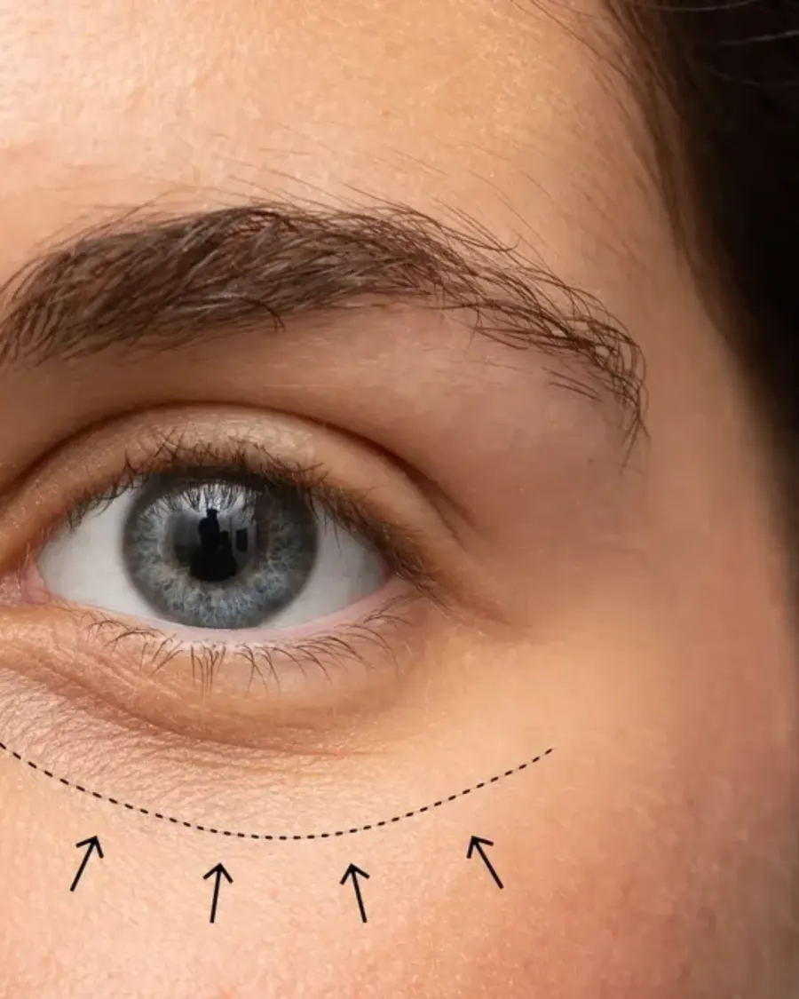 Advanced Eye Rejuvenation Treatments at Cinch Clinics